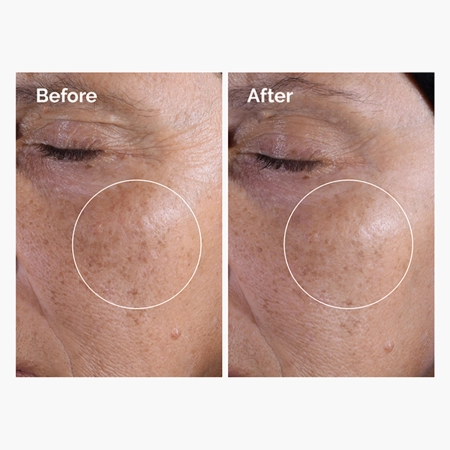 The Ordinary - Glycolic Acid 7% Exfoliating Toner - Hámlasztó Tonik 7% Glikolsavval - 100ml