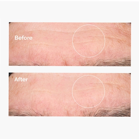 The Ordinary - Hyaluronic Acid 2% + B5 - Hidratáló Szérum 2%-os Hialuronsavval és B5-vitaminnal - 60ml
