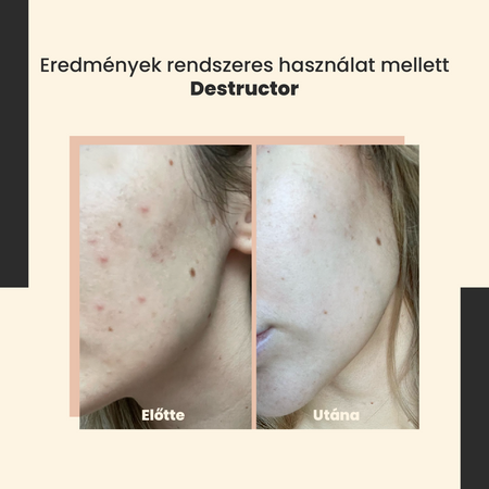 SkinTra - Destructor - Egész Évben Használható 24% Savas Peeling - 30ml