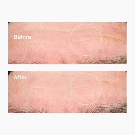 The Ordinary - Hyaluronic Acid 2% + B5 - Hidratáló Szérum 2%-os Hialuronsavval és B5-vitaminnal - 30ml