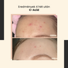 SkinTra - C-Acid - Savas Kezelés C-vitaminnal - 30ml