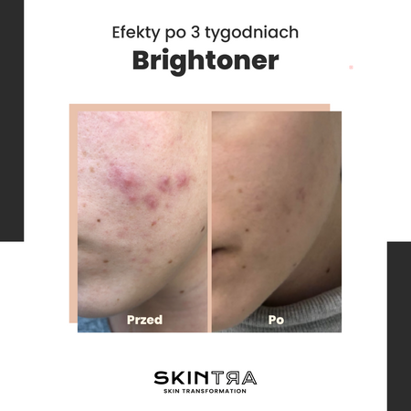 SkinTra - Brightoner - Egész Évben Használható 9%-os Savas Tonik - 100ml